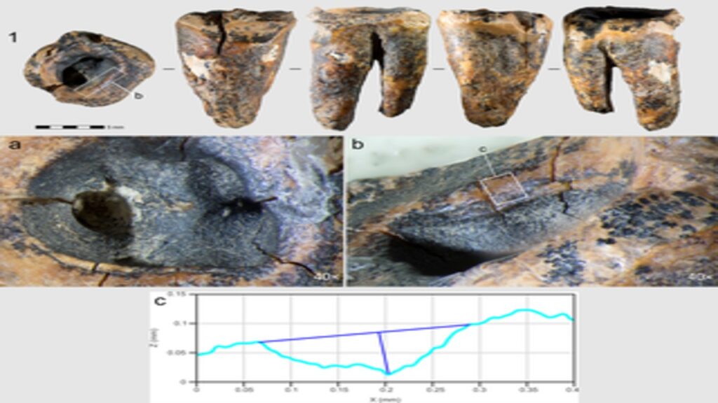 Cientistas afirmam que um dente neandertal de 59.000 anos apresenta evidências de cirurgia