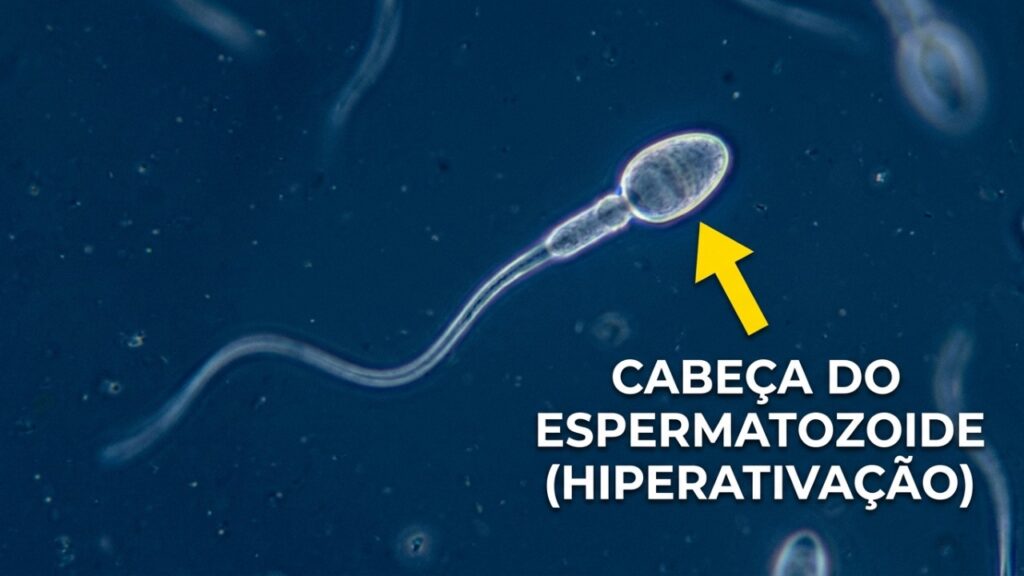 O HyperSperm, uma tecnologia inovadora desenvolvida por cientistas argentinos, ganhou destaque na medicina reprodutiva, pois além de aprimorar a fertilização, eleva consideravelmente as possibilidades de gestação